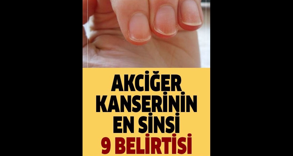 Akciğer Kanserinin En Sinsi 9 Bulgusu